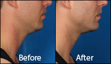 KYBELLA Patient 2 male