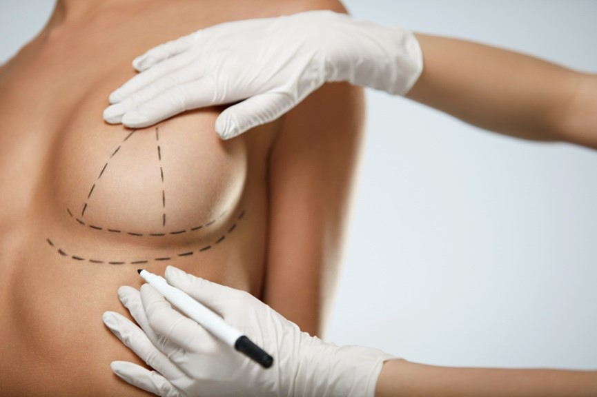 breast lift 1