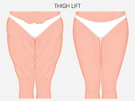 thigh lift 2