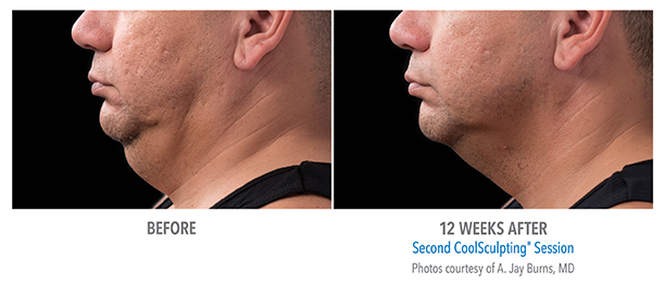 Before and After Image: Coolsculpting - left-side