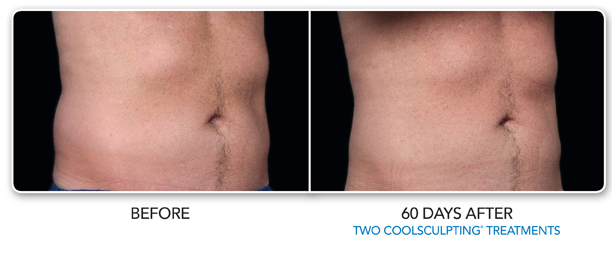 Before and After Image: Coolsculpting - right-front-oblique