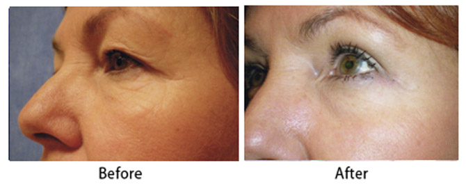 Before and After Image: Eyelid Surgery - left-front-oblique