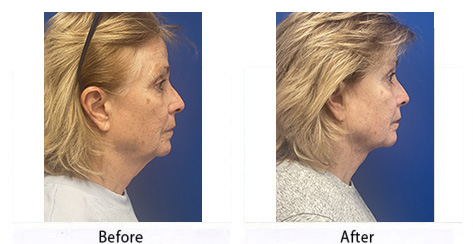 Before and After Image: FACEtite - right-side
