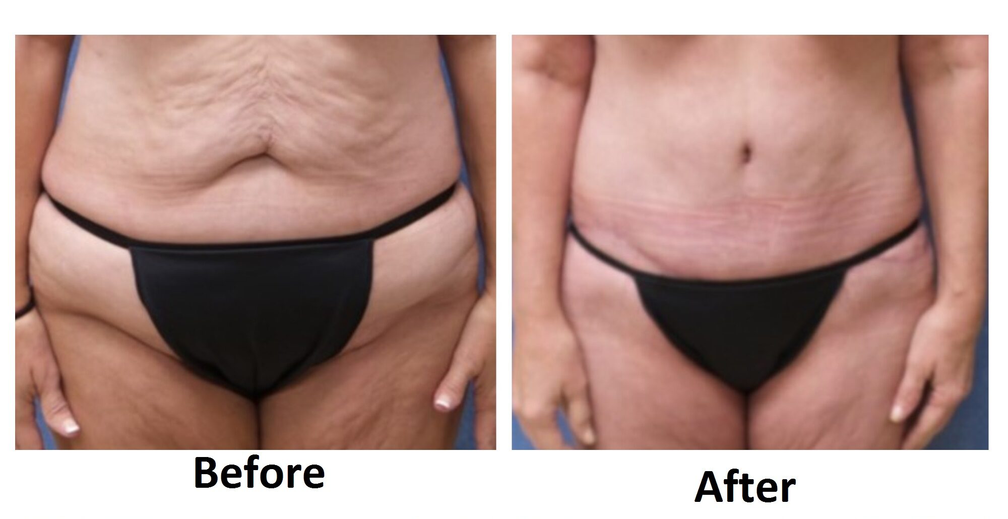 Before and After Image: Abdominoplasty - front