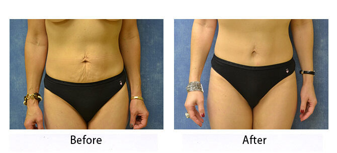 Before and After Image: Abdominoplasty - front