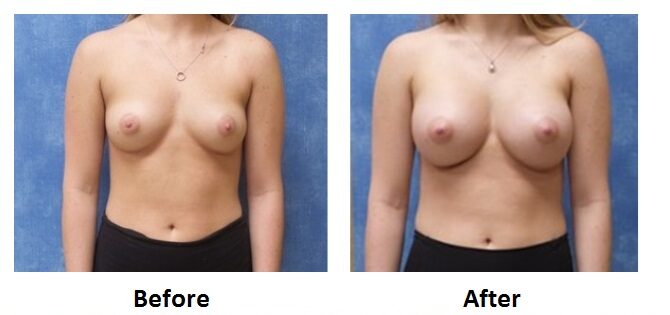 Before and After Image: Breast Augmentation - 