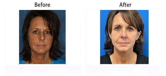 Before and After Image: FACEtite - front