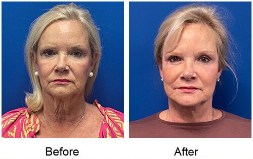 Before and After Image: Face and Neck Lift