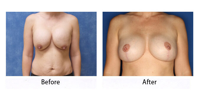 Before and After Image: Breast Lift - front