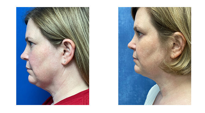Before and After Image: FACEtite - left-side