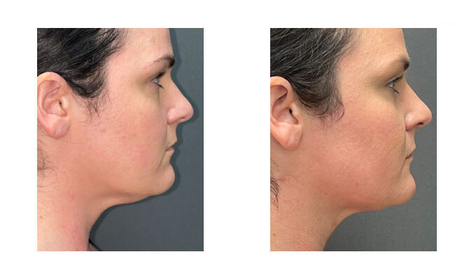 Before and After Image: FACEtite - right-side
