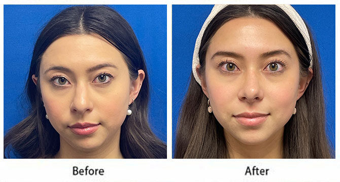 Before and After Image: Rhinoplasty - front