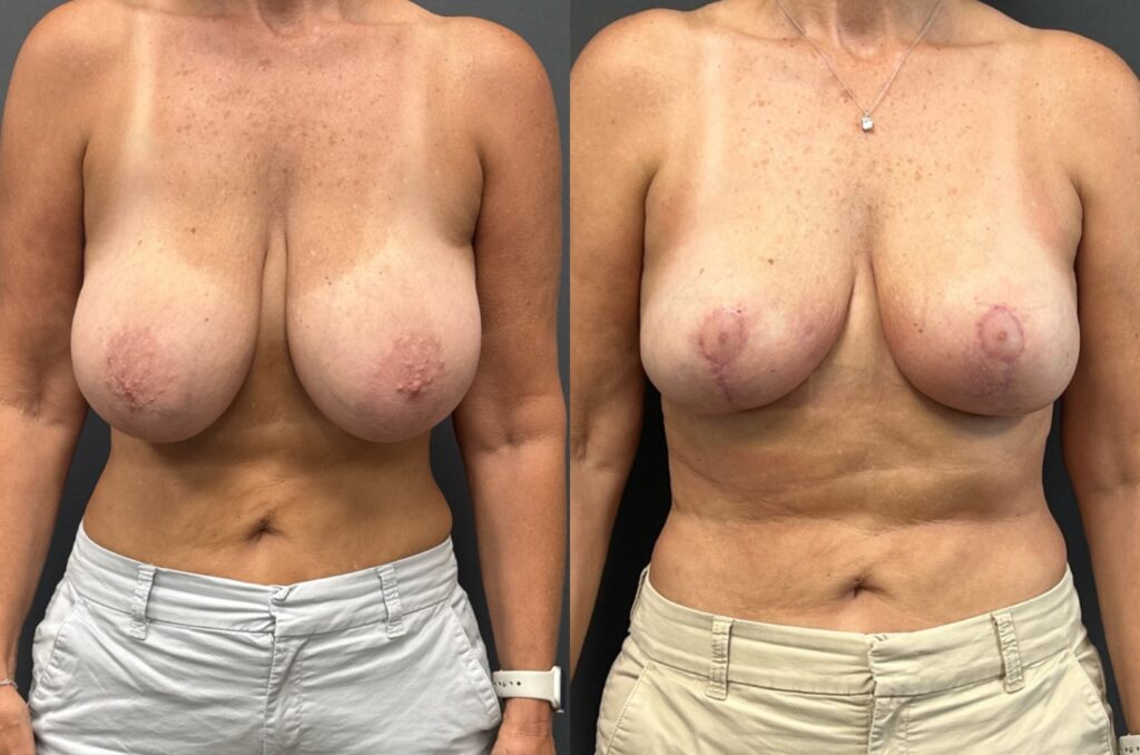 130749 Breast Reduction 3 mos post frontal