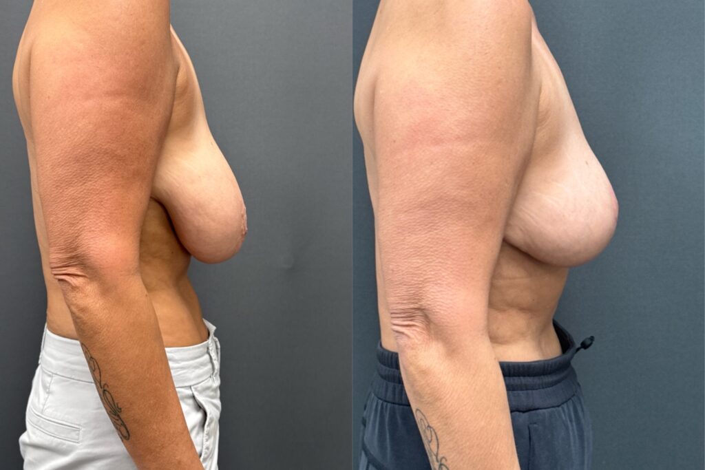 130749 Breast Reduction 3 mos post profile