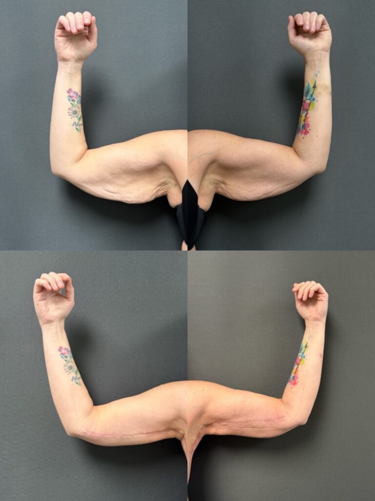 Brachioplasty 2