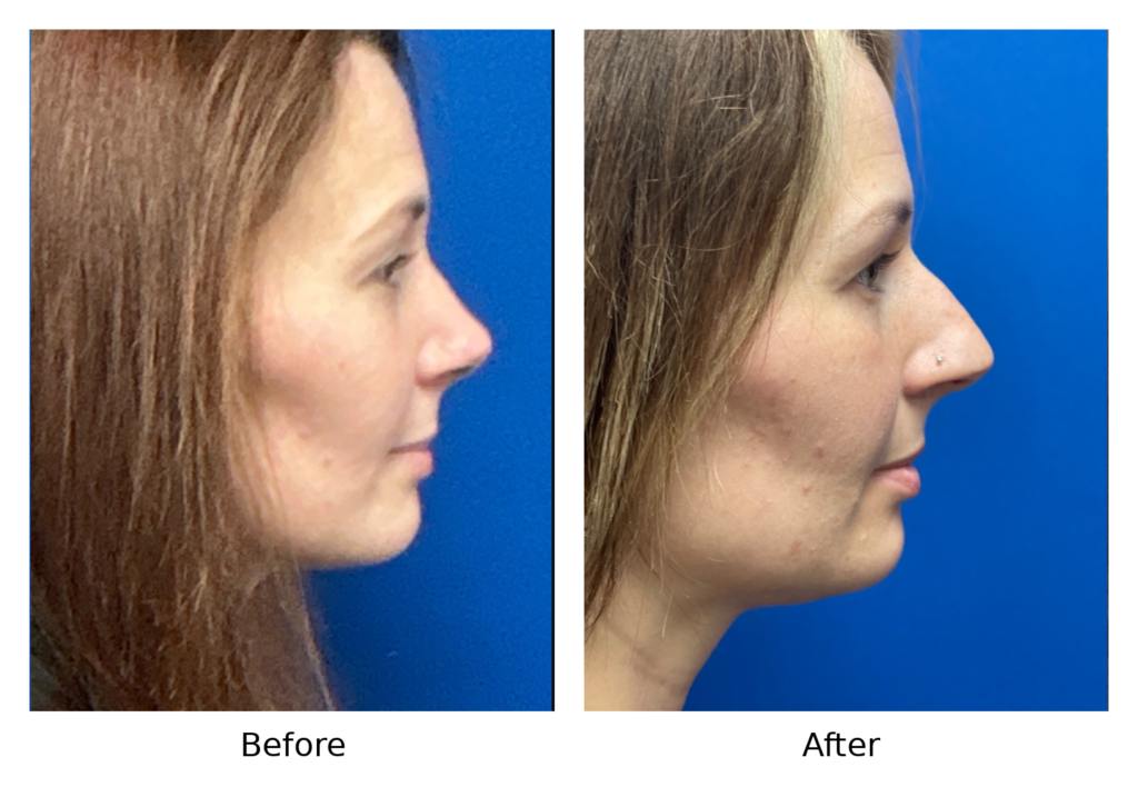 before after case 4