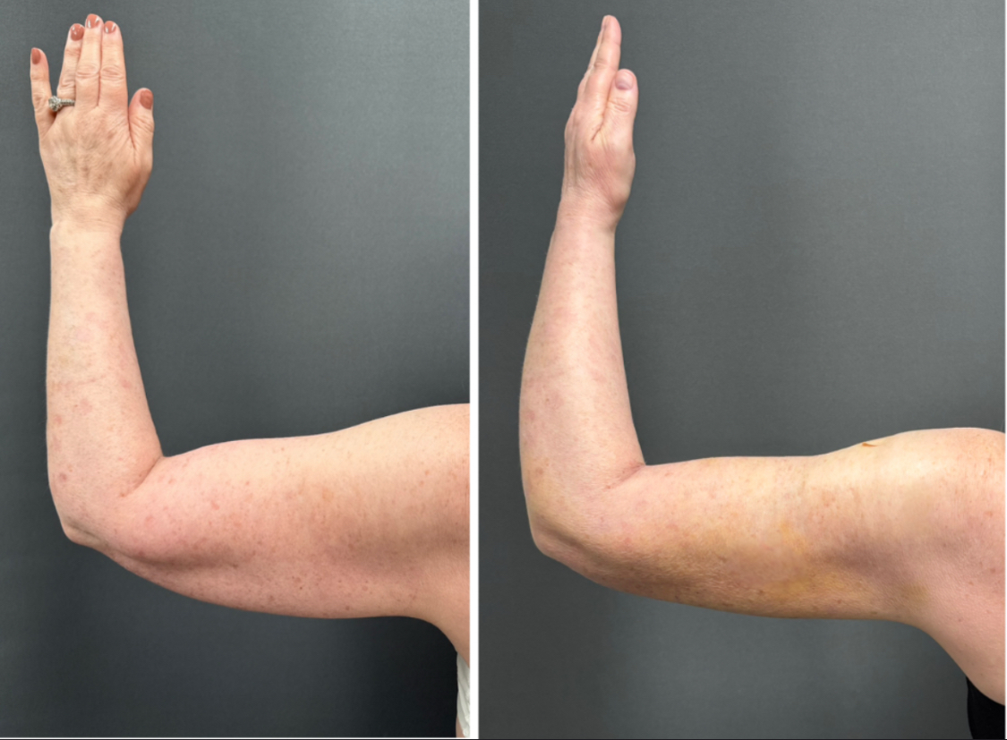 Before + After Photo At Two Weeks Post Procedure
